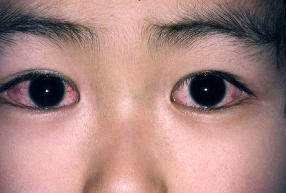 持续发热,眼唇红,草莓舌,出疹子,川崎病会要了娃的命