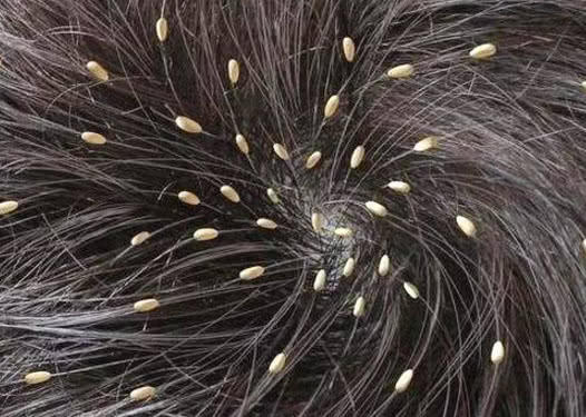 古代百姓容易 长虱子 现在却很 少见 虱子都 灭绝 了吗