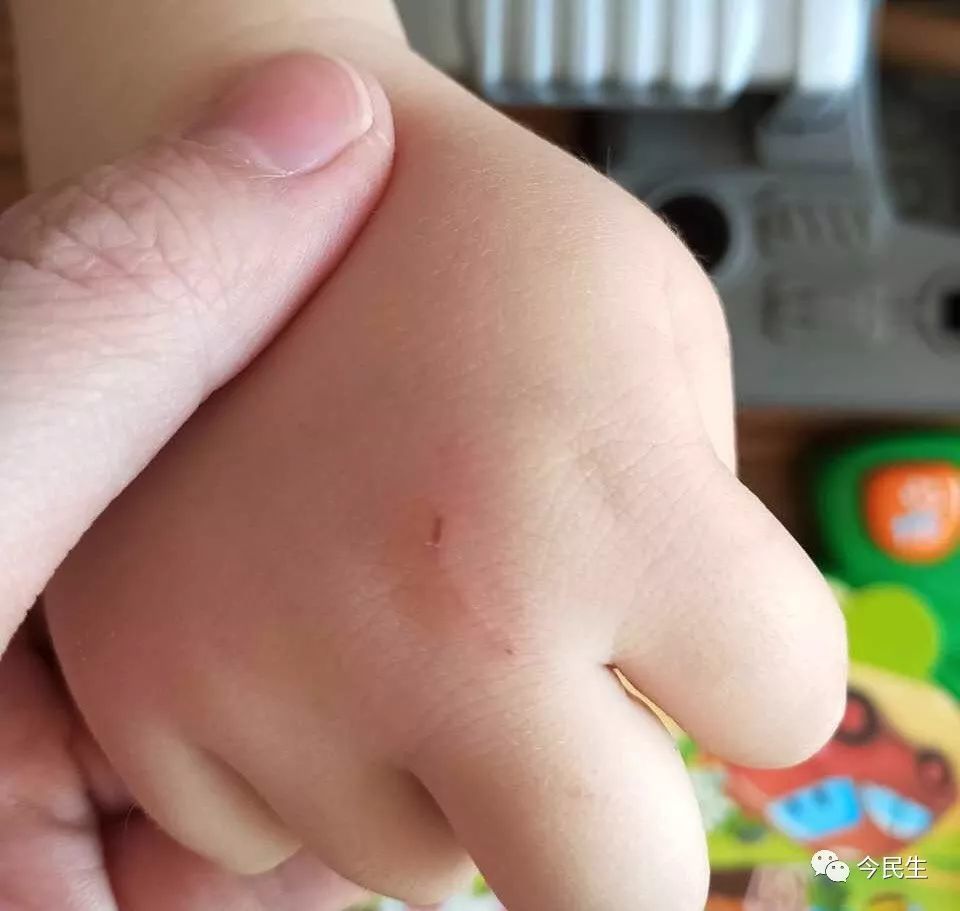 天津一小朋友在商场中被浣熊抓伤