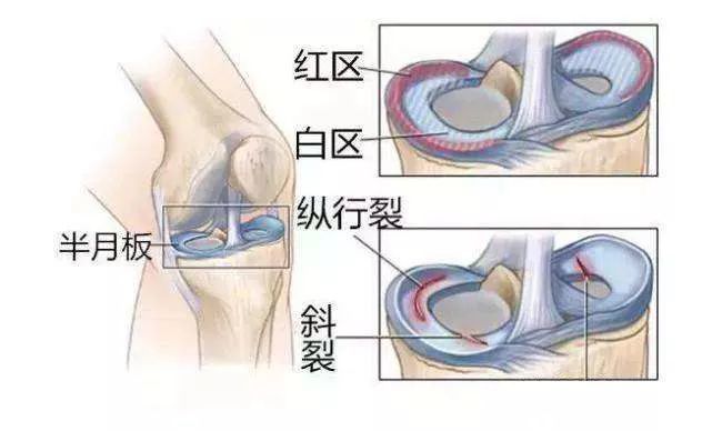 膝半月板位置图片图片