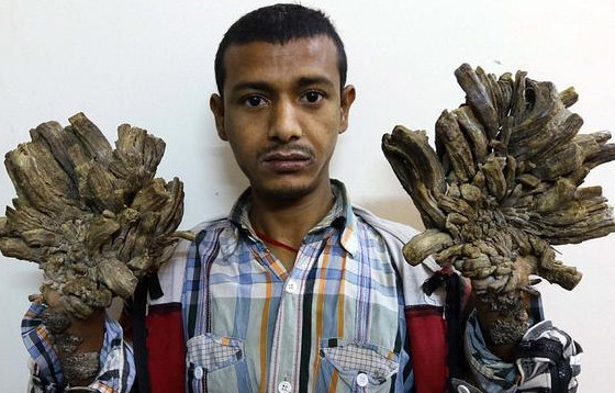 印度再出奇闻,男子身上长出树枝,网友:被树精附体