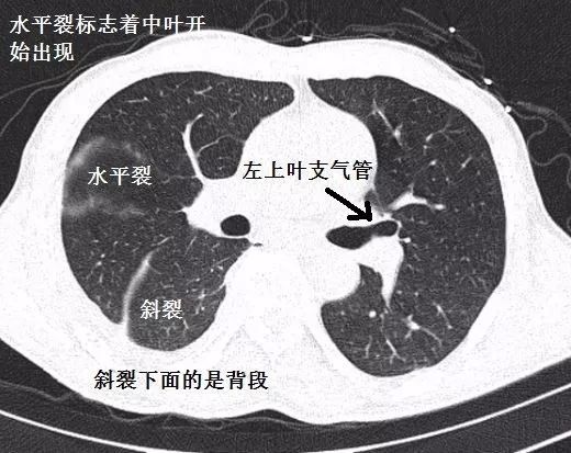 支氣管ct解剖最佳學習資料!|圖譜 視頻解說_騰訊新聞