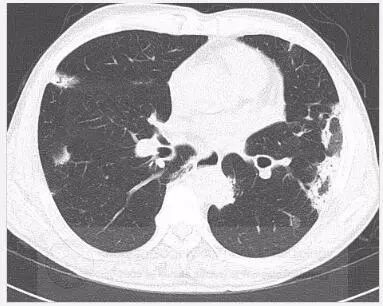 胸部ct顯示雙肺多灶性,斑片狀實變,伴中央空氣支氣管徵,以及外周磨