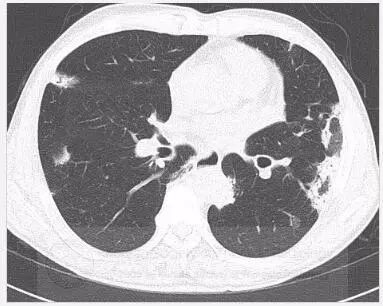 患者无特异性症状双肺斑片状实变的原因是丨以影识病