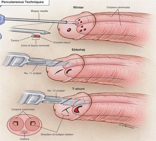 常德16岁男孩阴茎连续勃起3天背后原因令人心酸