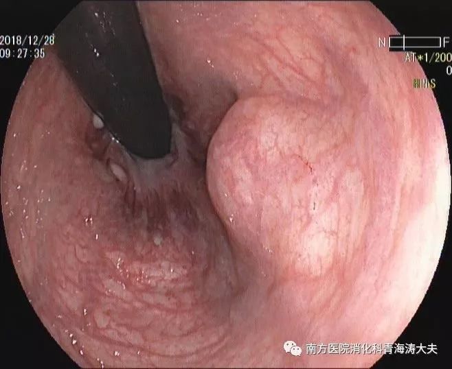 内镜下切除直肠肛管附近4cm巨大间质瘤