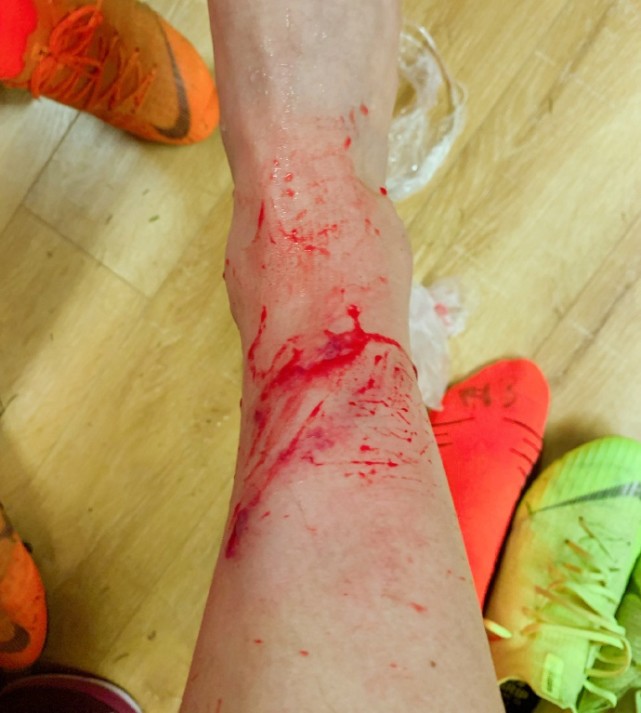 血淋淋!女足国脚晒伤口照片:没有白走的路也没有白受的苦