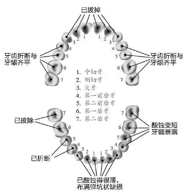 19歲高中生一口牙齒拔掉8顆折斷10顆醫生可能全國都找不出第二例