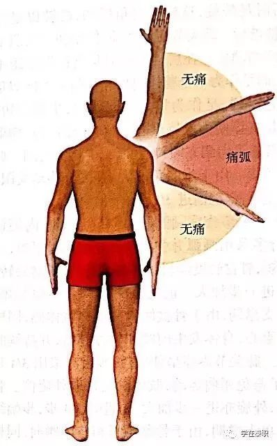 120°範圍內出現疼痛(圖1)在此範圍以外則無疼痛,也見於岡上肌腱炎