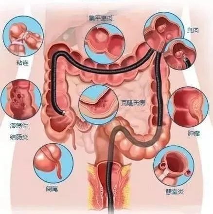 超全講解胃鏡結腸鏡小腸鏡超聲內鏡無痛內鏡舒適胃鏡精查胃鏡膠囊內鏡