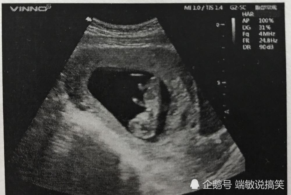 怀孕初期有出血症状是什么原因 如果是这种情况不用太惊慌 腾讯新闻