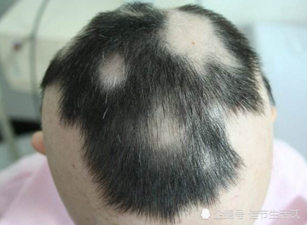 脱发