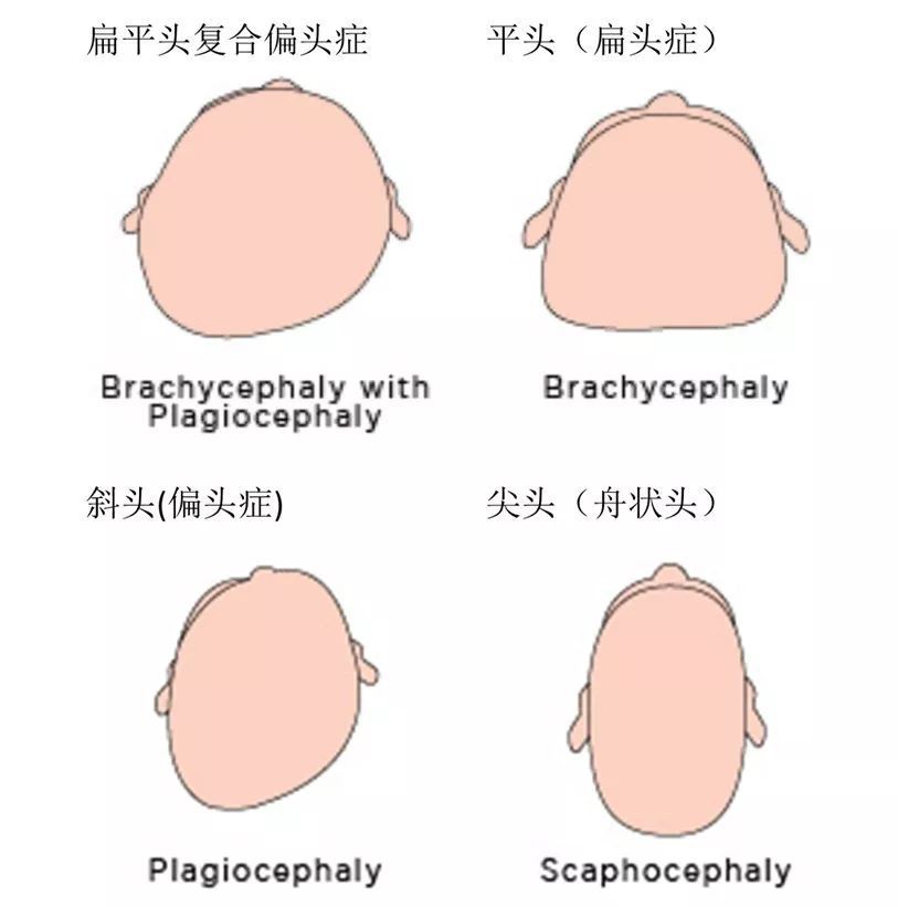 后脑勺|为什么别人有个圆润的后脑勺，我的却是扁的？