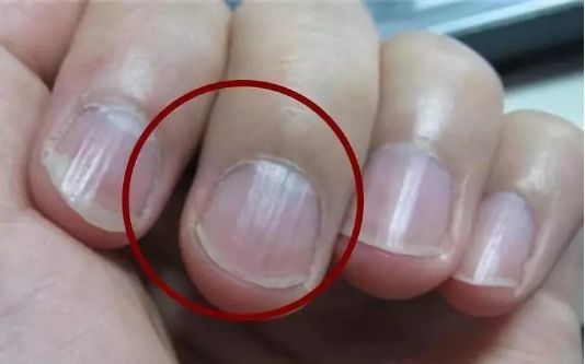 手上出现4个症状肝可能不好