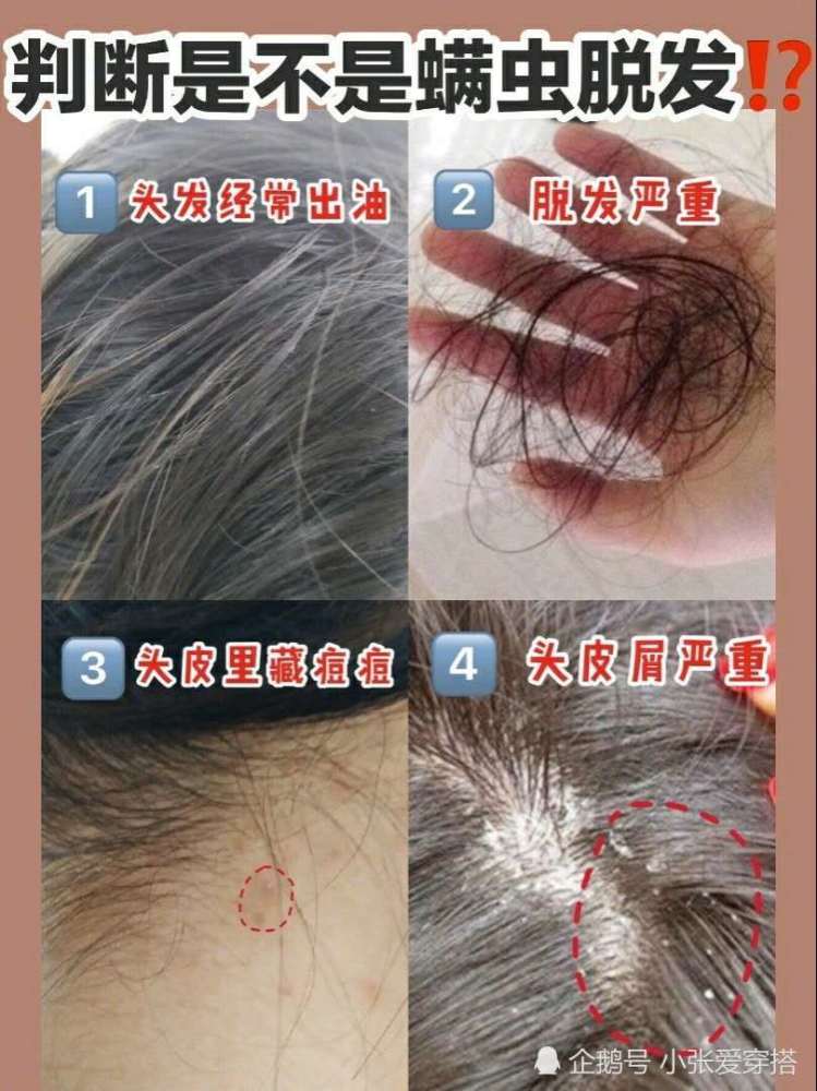 头螨真要命!每天只要五分钟,拒绝秃头少女,轻松解决大油头
