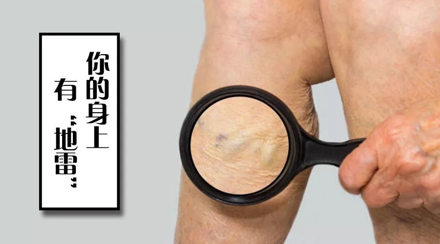 艾灸散结,去筋疙瘩!拉筋 艾灸散结,体内百病消