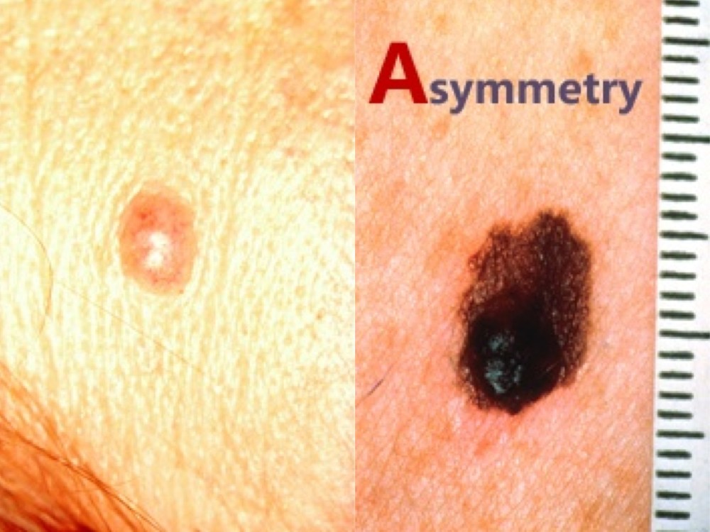 较真| 北大肿瘤医院副院长郭军:啥样的痣会恶变成黑色素瘤?