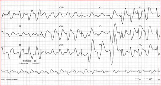 低血钾心电图表现图形图片