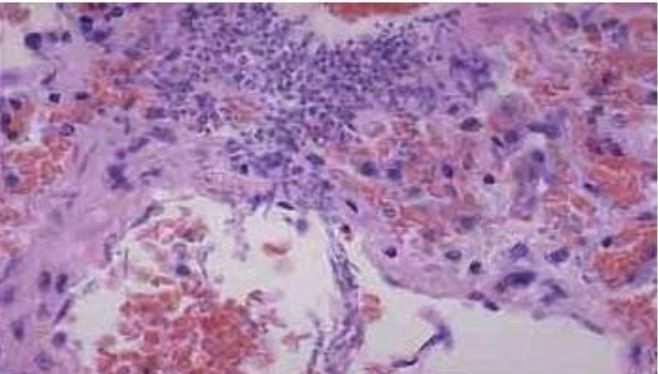 被美国列为紧急威胁的超级真菌,会在中国爆发