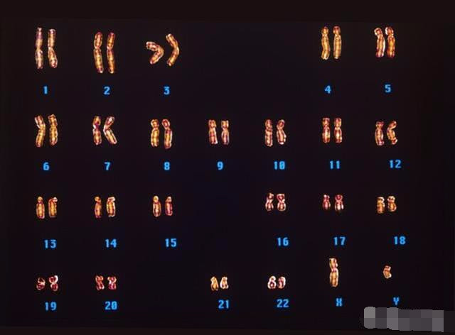 染色体异常会出现哪些情况,胎儿染色体异常会怎样?