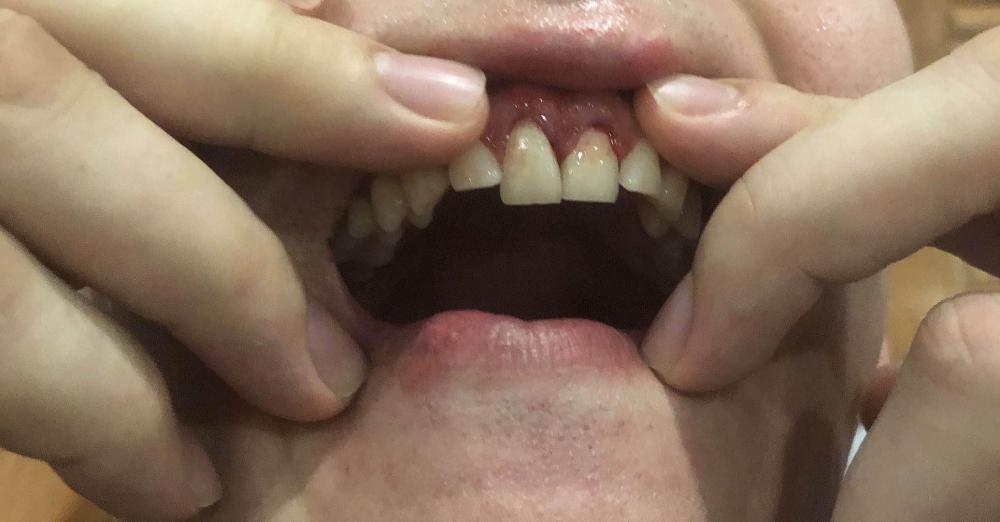 太拼了!新疆队长门牙错位 或面临换牙仍选择战斗到底