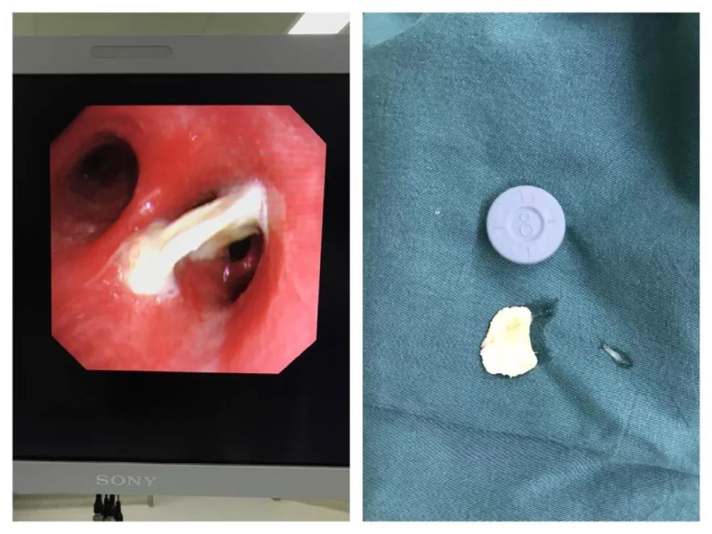 超2厘米异物卡气管!嘉定患者咳血!医生看了吓一跳!
