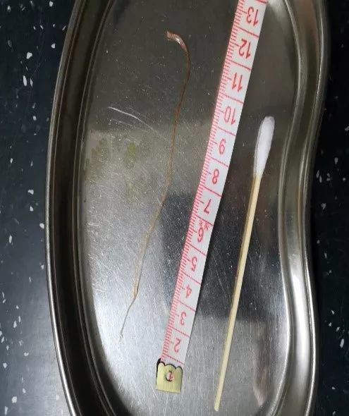 picc保管268天,长出了什么?看后让人震惊!