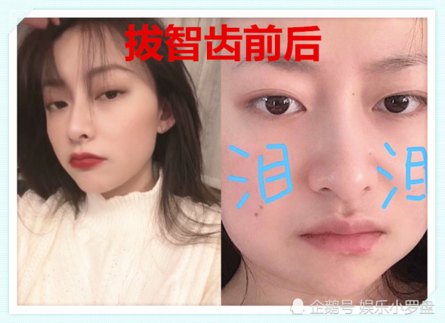 拔智齿前vs拔智齿后 脸型随意扭曲 网友 先让我笑几分钟 腾讯网