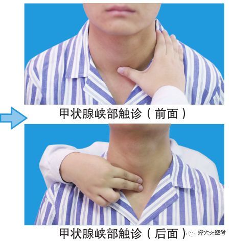 甲状腺峡部触诊:检查者站于被检查者前面,用拇指(或站于受检者后面用