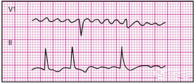 典型异常心电图图谱图片