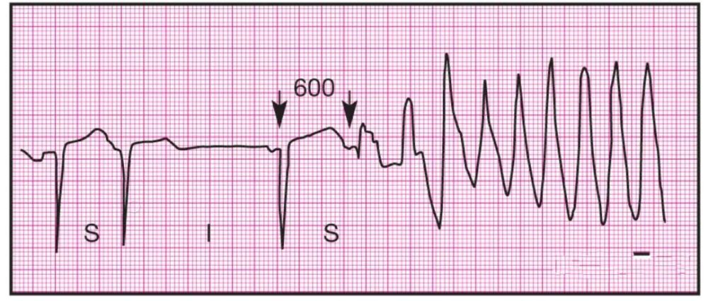 【干货收藏】14种异常心电图的波形特点