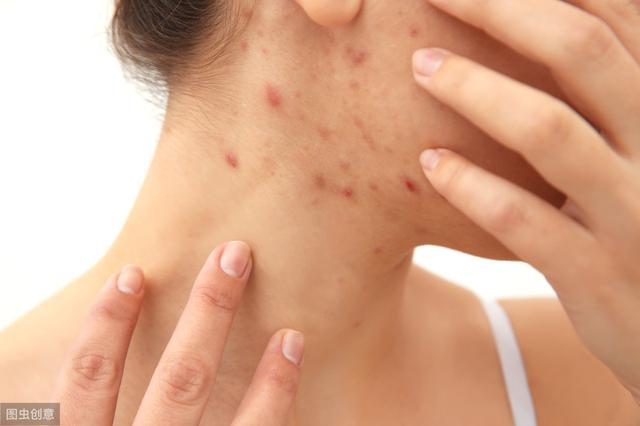 皮肤经常干燥瘙痒 那是身体在 报警 4种诱发疾病了解一下 过敏 瘙痒 皮肤干燥 湿疹 神经性皮炎