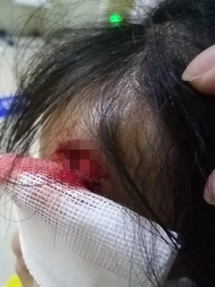 游乐园又出事长沙4岁女童春游受伤头部缝十针