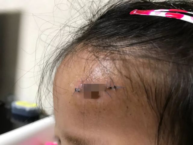 游乐园又出事!长沙4岁女童春游受伤头部缝十针