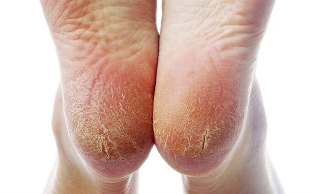 脚干,脚气,脚痛,泡脚的时候倒点"它",问题全解决