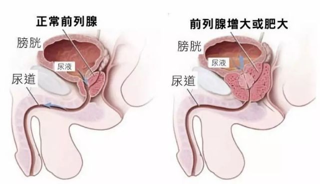 人口增生_疤痕增生图片