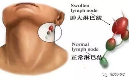 儿童颈部淋巴结肿大警惕恶性肿瘤!