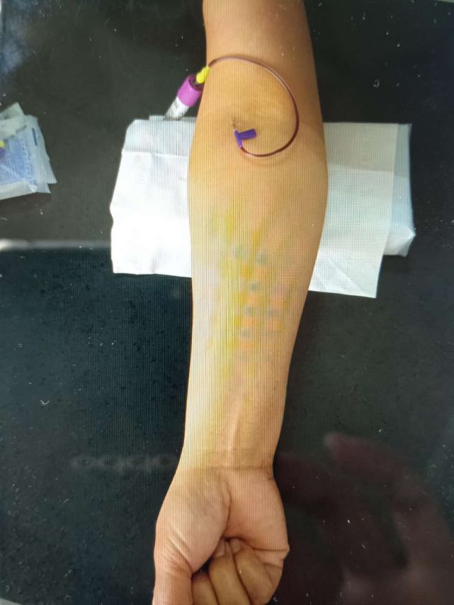 患者采血静脉看不见一招快速搞定