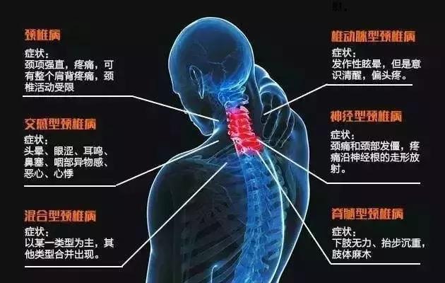 落枕 可不是小事 可能是颈椎病的前兆 腾讯网