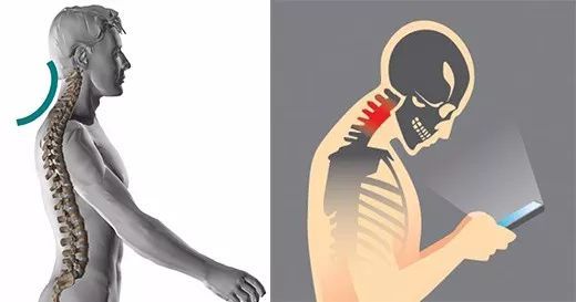 颈椎反弓变直肩颈疼痛怎么办