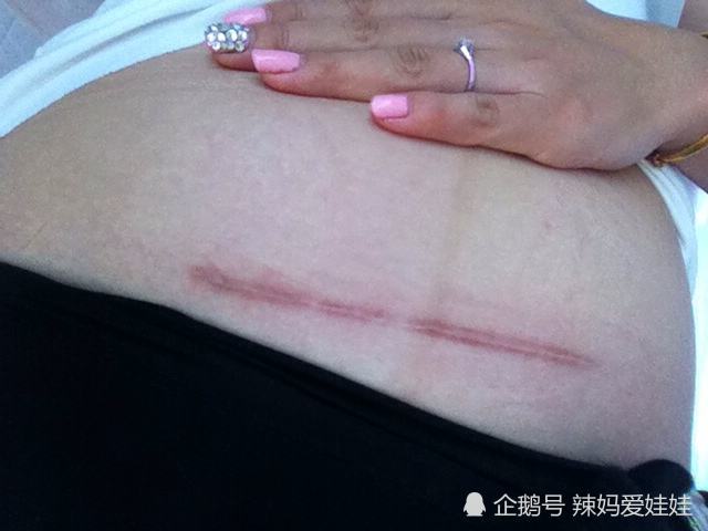 剖腹产之后,伤口多久能愈合?医生:分3种情况