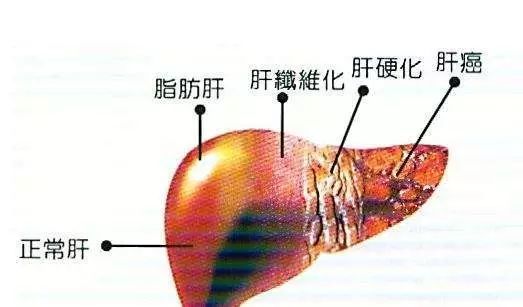 5个人里就有1个有这种肝病,现在还来得逆转,千万别拖成癌!