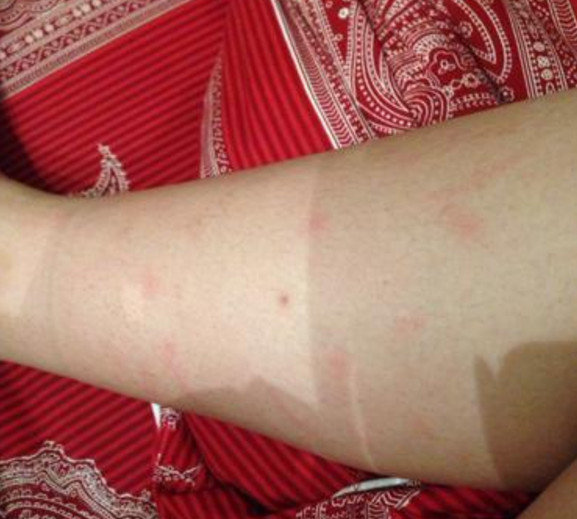 体检查出u201c糖尿病u201d？皮肤一旦出现这3种症状，十有八九已中招了_腾讯网