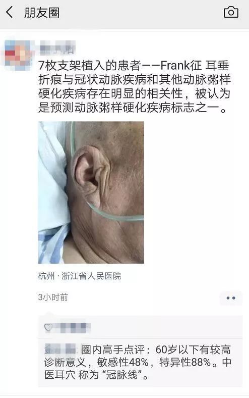 福相浙江大伯耳垂有明显折痕可老伴说这是病结果