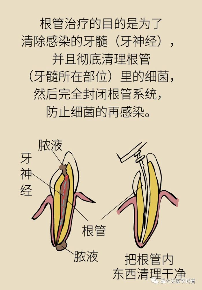"杀神经"治牙,牙是不是就"死"了?三大真相在此_腾讯新闻