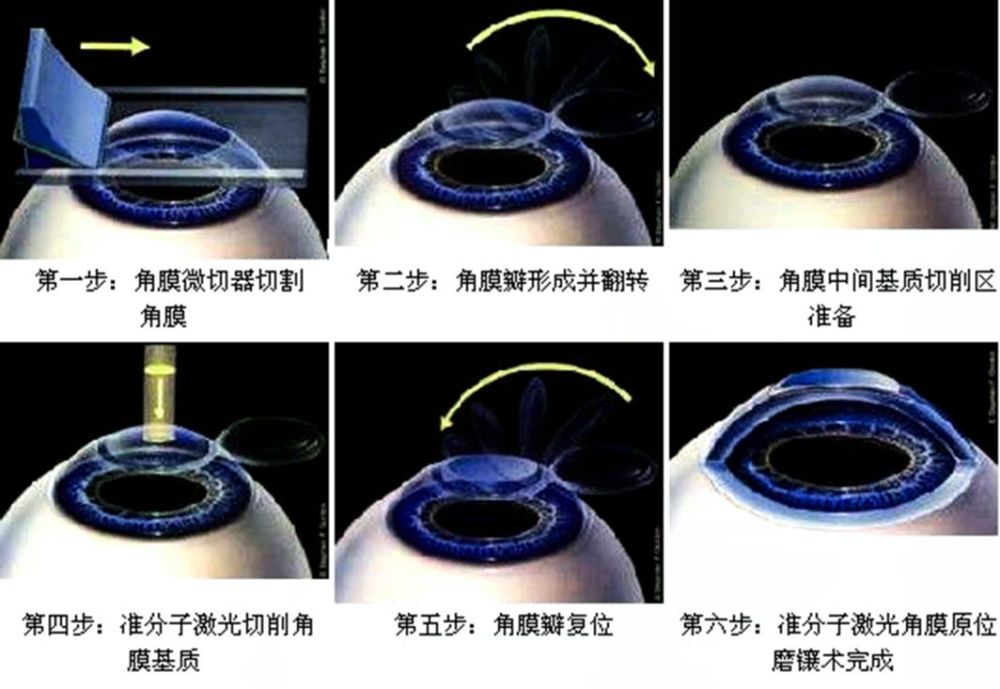 圖文解讀丨飛秒全飛秒準分子激光手術的區別