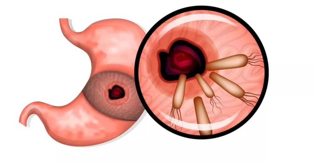 现实中的幽门螺旋杆菌比你想象中的更加"可恶"一些.