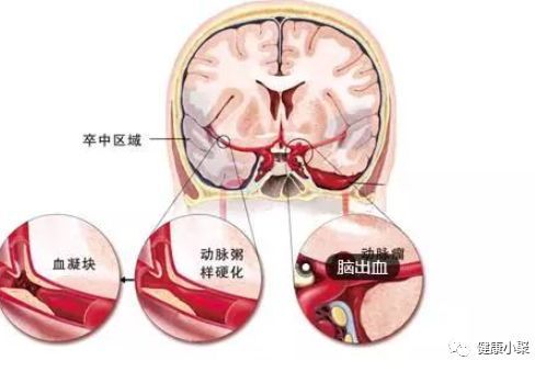 脑梗塞,脑梗死,症状