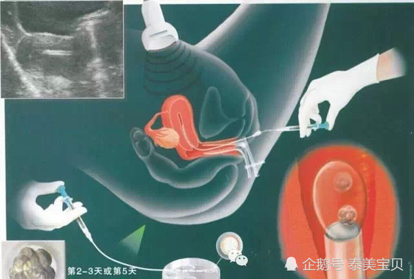 腹痛 出血 饮食 盘点试管婴儿移植后常见疑问