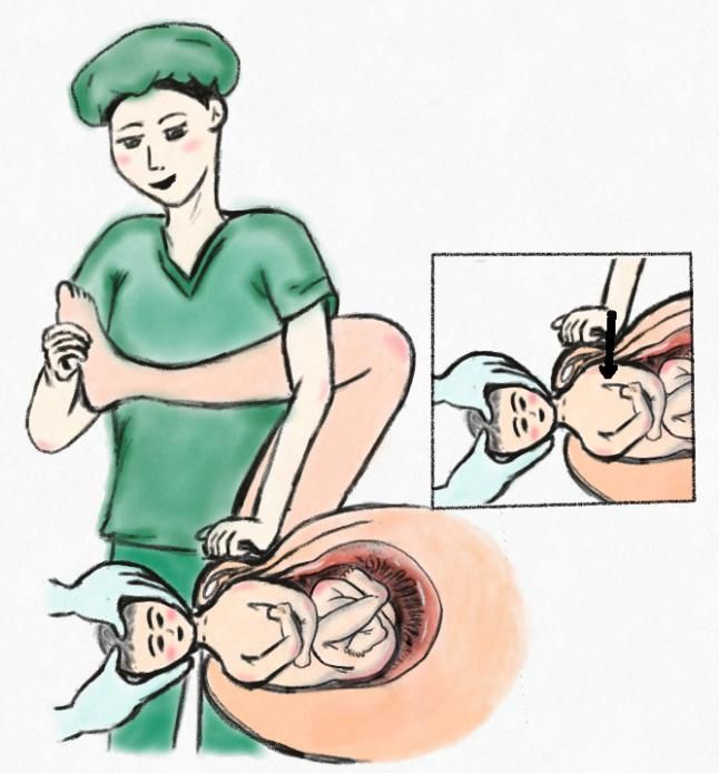 新生儿腰骶部凹陷图片图片